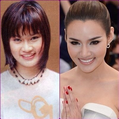 Plastic surgery on Thai people - before and after pics - The Bangkok Forum - Bangkok Forum